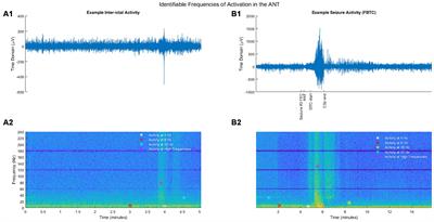 Anterior thalamic nucleus local field potentials during focal temporal lobe epileptic seizures